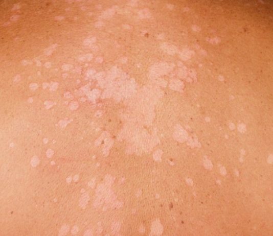 Các biểu hiện tổn thương bệnh da liễu bệnh lang ben