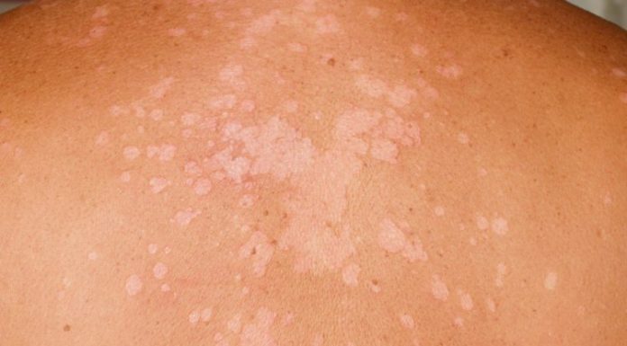 Các biểu hiện tổn thương bệnh da liễu bệnh lang ben