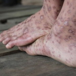 Điều trị lao da