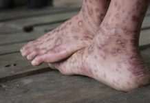 Điều trị lao da