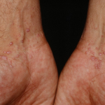 Điều trị bệnh Lichen phẳng