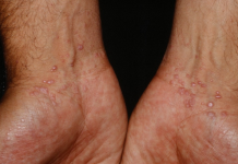 Điều trị bệnh Lichen phẳng