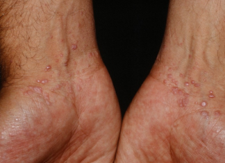 Điều trị bệnh Lichen phẳng