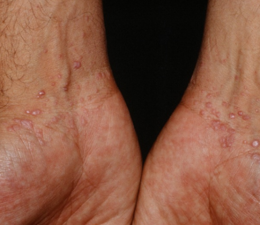 Điều trị bệnh Lichen phẳng