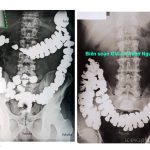 THĂM DÒ HÌNH THÁI ĐƯỜNG TIÊU HÓA BẰNG PHƯƠNG PHÁP CHỤP X QUANG
