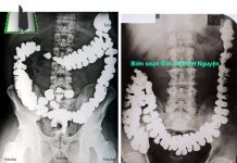 THĂM DÒ HÌNH THÁI ĐƯỜNG TIÊU HÓA BẰNG PHƯƠNG PHÁP CHỤP X QUANG