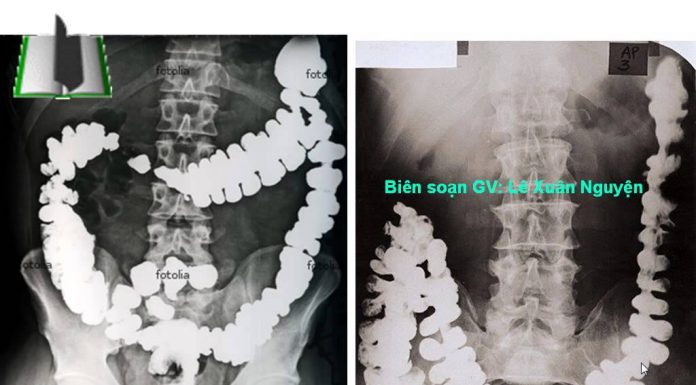 THĂM DÒ HÌNH THÁI ĐƯỜNG TIÊU HÓA BẰNG PHƯƠNG PHÁP CHỤP X QUANG