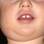 Những điều cần biết về triệu chứng âm sàng của bệnh quai bị