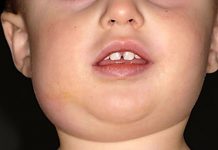 Những điều cần biết về triệu chứng âm sàng của bệnh quai bị