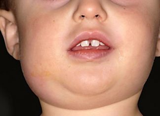 Những điều cần biết về triệu chứng âm sàng của bệnh quai bị