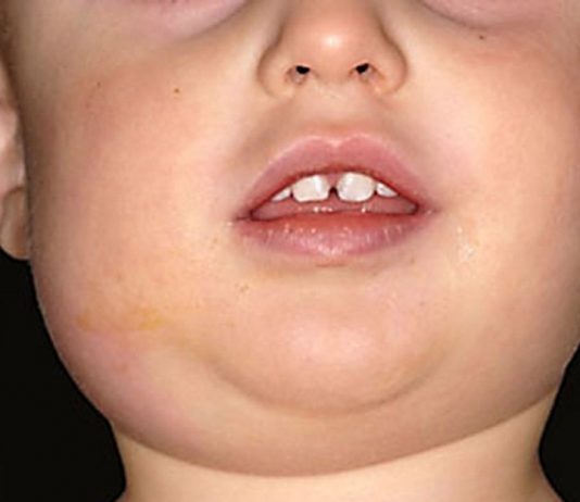 Những điều cần biết về triệu chứng âm sàng của bệnh quai bị