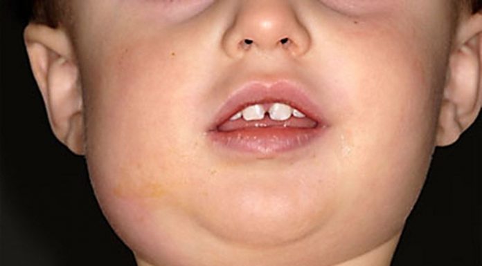 Những điều cần biết về triệu chứng âm sàng của bệnh quai bị
