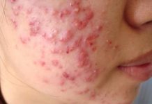 Điều trị và phòng bệnh nhọt mụn trứng cá