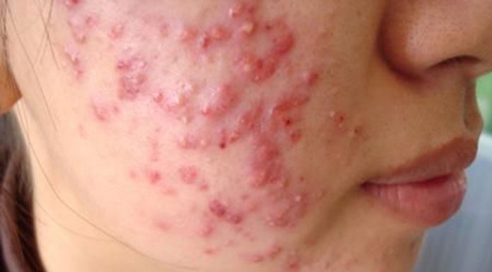 Các thể trứng cá mụn trứng cá