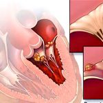 Sinh lý bệnh – bệnh thấp tim