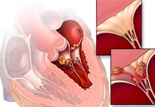 Nghiên cứu đại thể bệnh thấp tim cấp tính.
