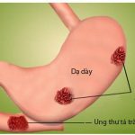 TRIỆU CHỨNG LOÉT DẠ DÀY TÁ TRÀNG