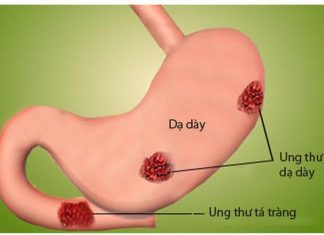 ung thư dạ dày: Dịch tễ và giải phẫu bệnh