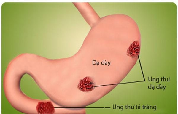 ung thư dạ dày: Dịch tễ và giải phẫu bệnh