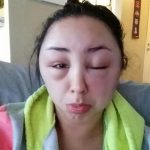 Cơ chế gây phù nguyên phát.