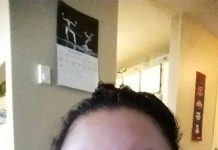 Cơ chế gây phù nguyên phát.