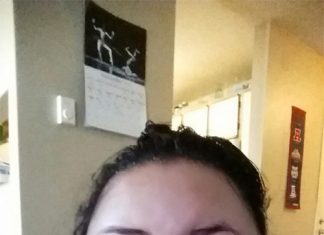 Cơ chế gây phù nguyên phát.