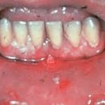 Các loại pemphigus pemphigus