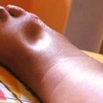 Một số điều cần biết về diễn biến lâm sàng của suy thận cấp