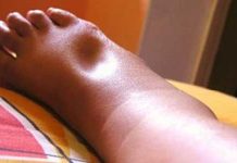 Một số điều cần biết về diễn biến lâm sàng của suy thận cấp