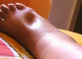 Một số điều cần biết về diễn biến lâm sàng của suy thận cấp