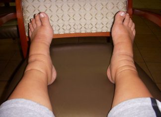 Cơ chế thứ phát gây phù