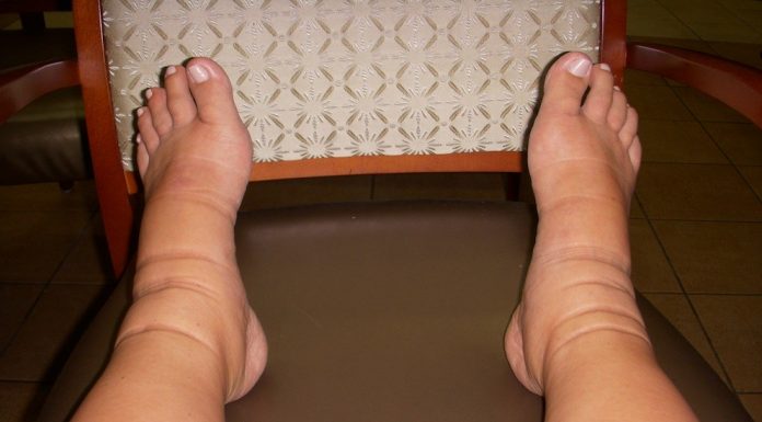 Cơ chế thứ phát gây phù