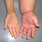 Phân loại nguyên nhân phù theo lâm sàng.