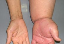 Nhận định tính chất phù trong lâm sàng.