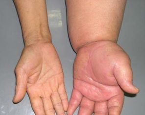 Nhận định tính chất phù trong lâm sàng.