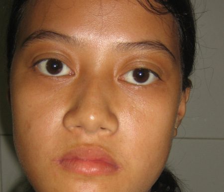 Phương pháp điều trị bệnh basedow.