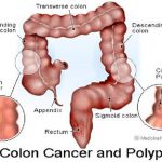 Kỹ thuật cắt polyp đại trực tràng qua nội soi