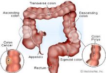 Kỹ thuật cắt polyp đại trực tràng qua nội soi