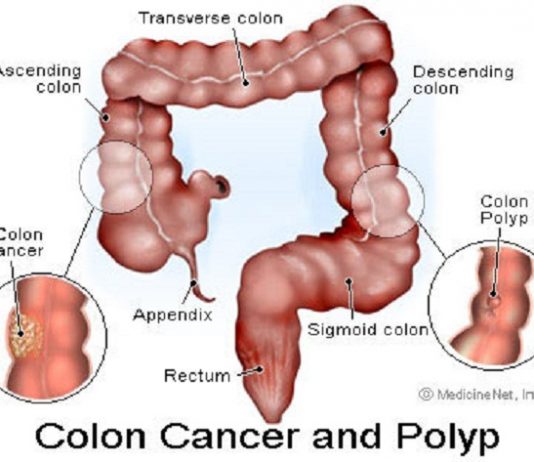 Kỹ thuật cắt polyp đại trực tràng qua nội soi