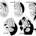 Chẩn đoán và triệu chứng của chấn thương thận.