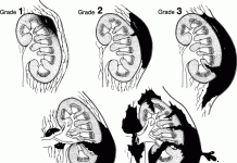 Chẩn đoán và triệu chứng của chấn thương thận.