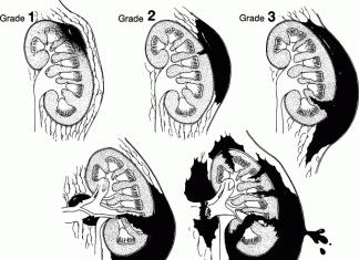 Chẩn đoán và triệu chứng của chấn thương thận.