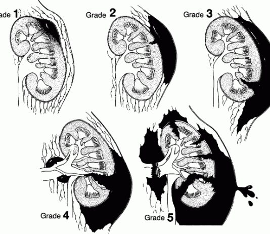 Chẩn đoán và triệu chứng của chấn thương thận.