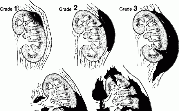 Chẩn đoán và triệu chứng của chấn thương thận.