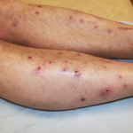 Điều trị bệnh sẩn ngứa