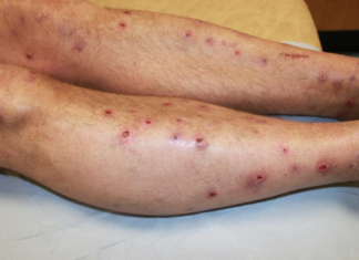 Điều trị bệnh sẩn ngứa