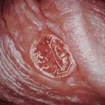 Các thể bệnh giang mai