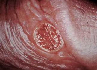 Các thể bệnh giang mai