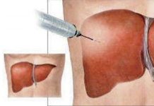 Sinh thiết gan qua đường tĩnh mạch. Chọc sinh thiết dưới hướng dẫn của siêu âm