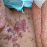 Điều trị Hội chứng Stevens-Johnson